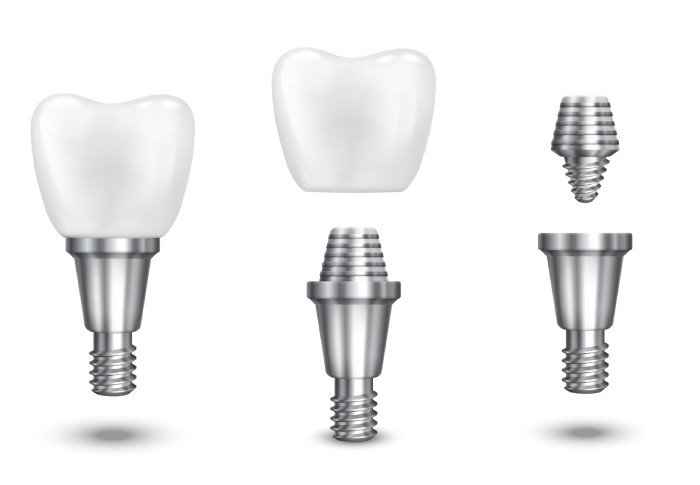 Implantes Dentários