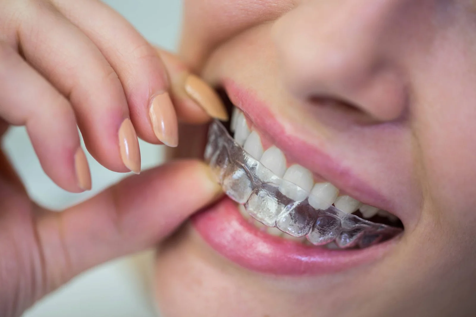 Close-up de paciente ajustando alinhador transparente ClearCorrect nos dentes em clínica no Anália Franco e Tatuapé.